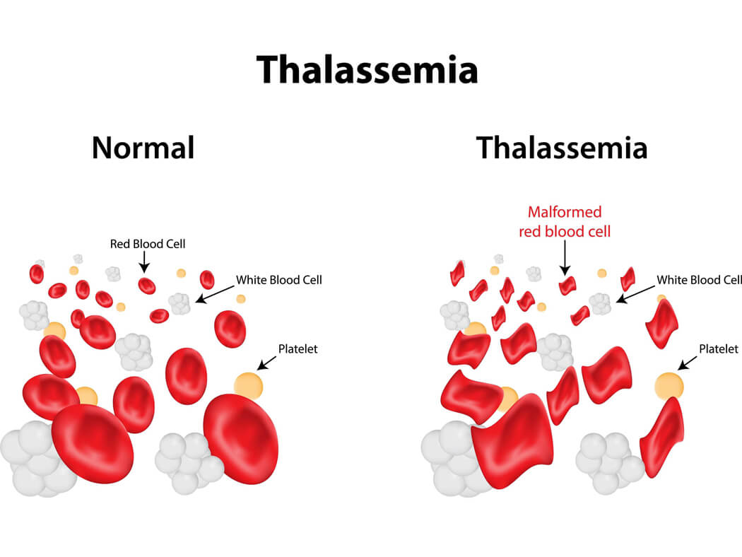 bệnh Thalassemia - bệnh tan máu bẩm sinh 