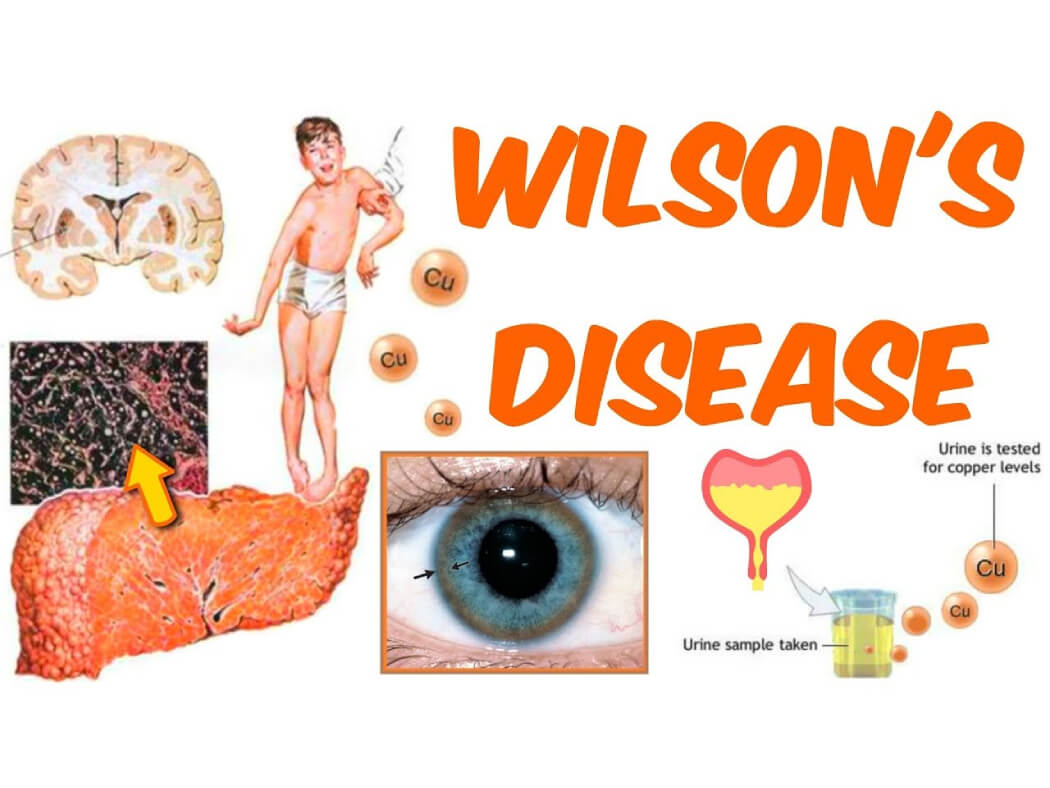 bệnh wilson