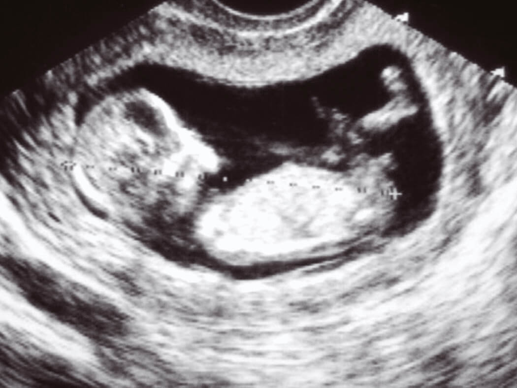 siêu âm thai nhi 12-13 tuần tuổi