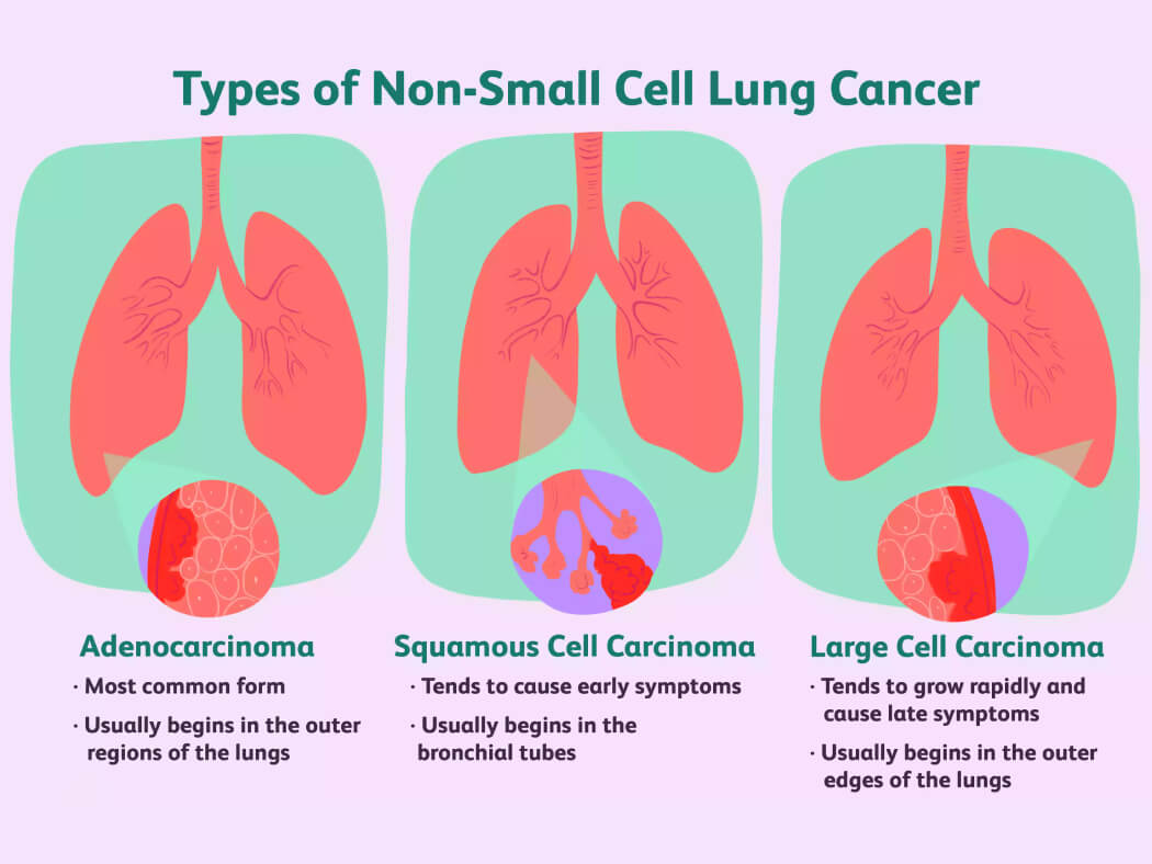 ung thư phổi không tế bào nhỏ