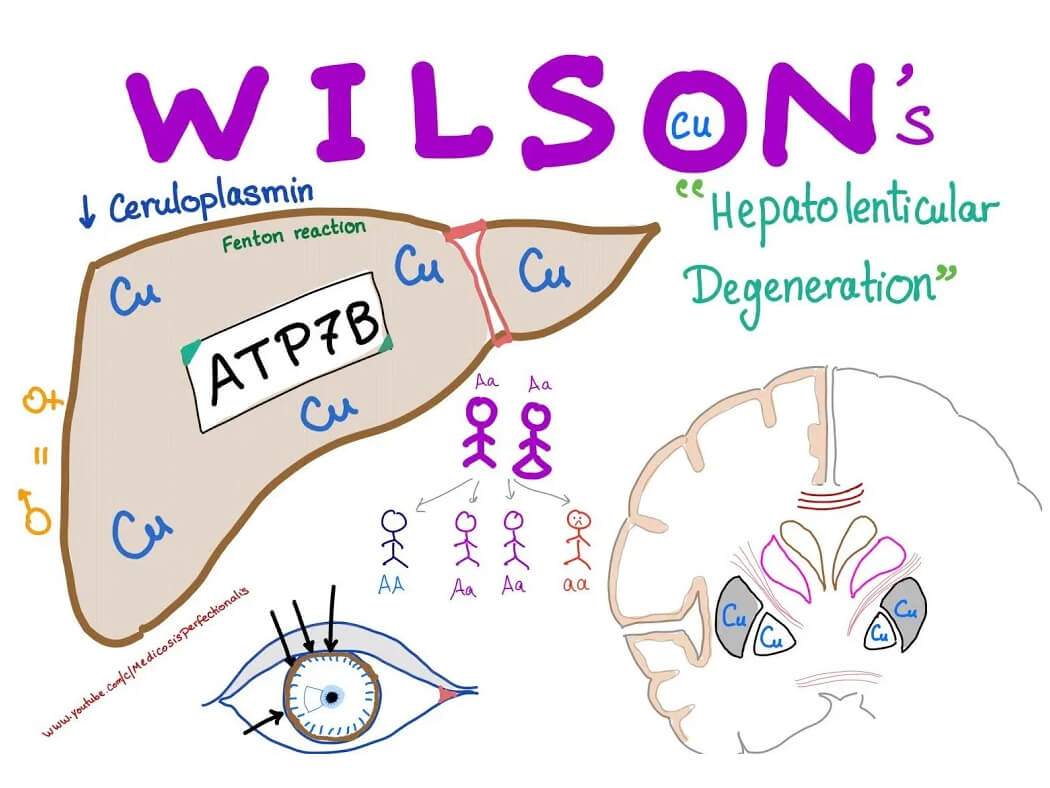 Wilson - bệnh di truyền gen lặn
