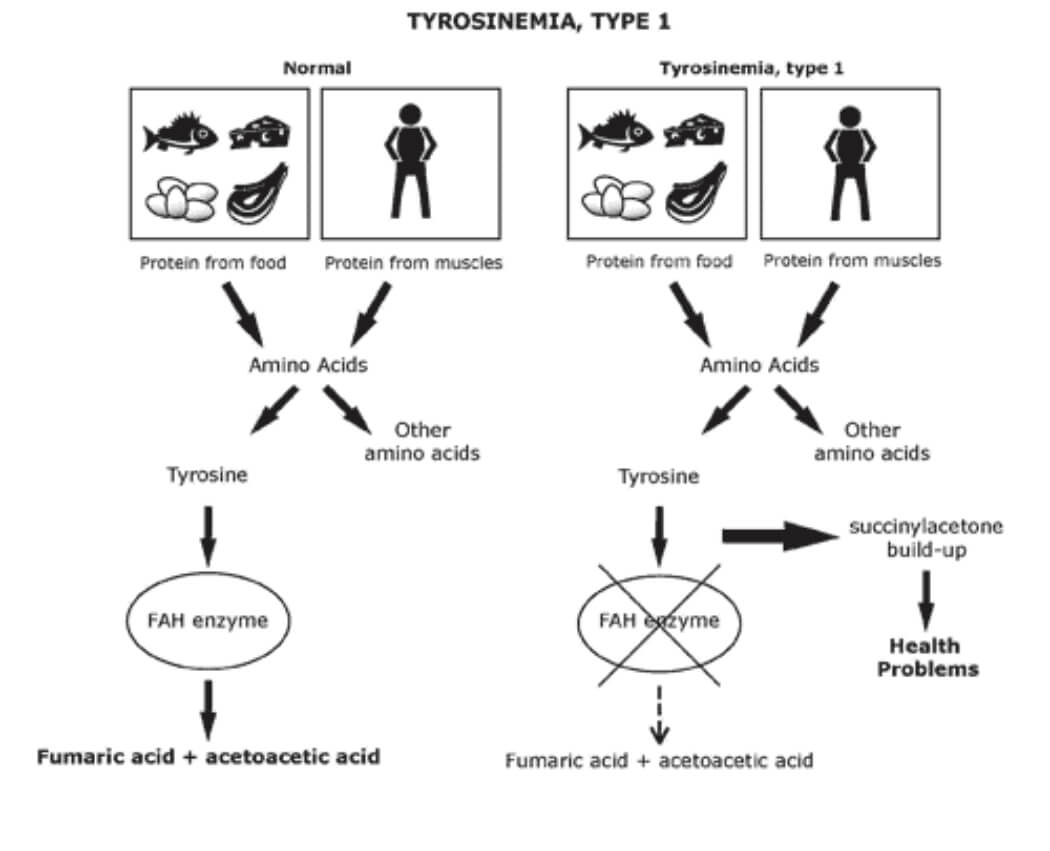 rối loạn chuyển hóa tyrosine loại 1