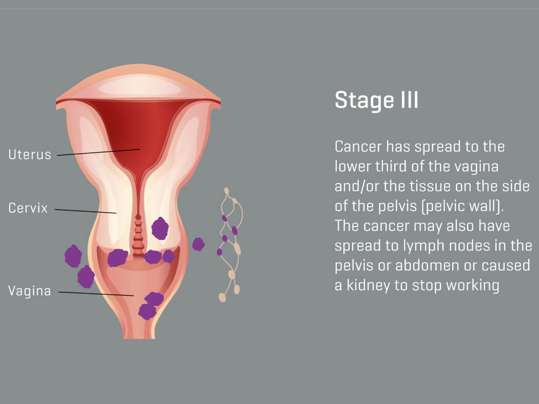 ung thư cổ tử cung giai đoạn 3