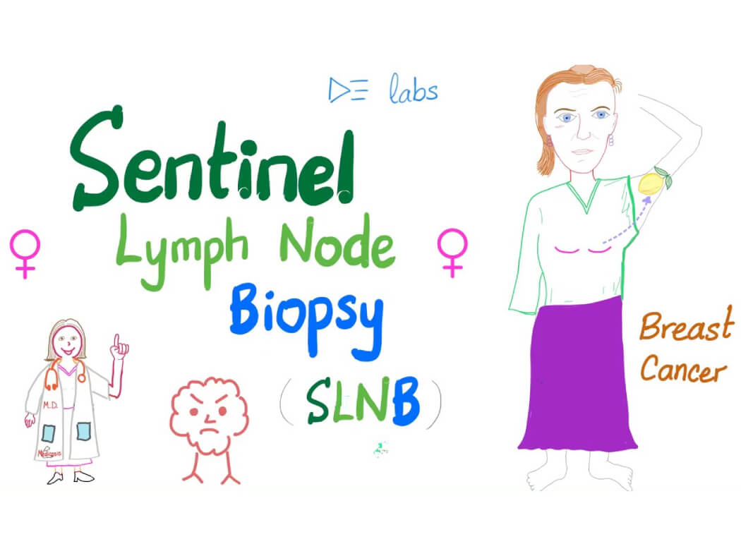 sinh thiết hạch bạch huyết Sentinel - SLNB