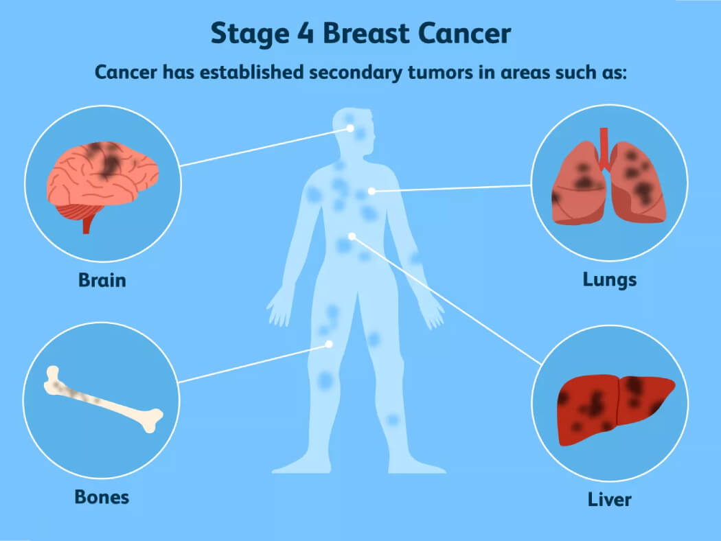 ung thư vú giai đoạn 4