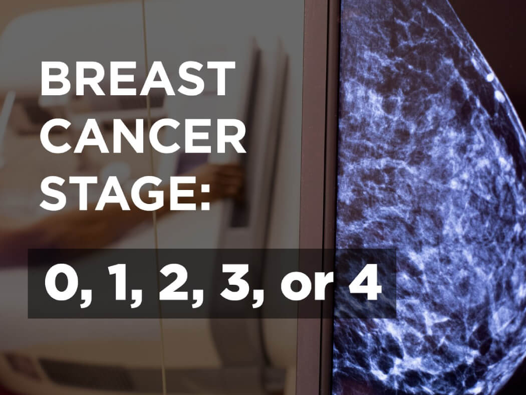 xác định giai đoạn ung thư vú