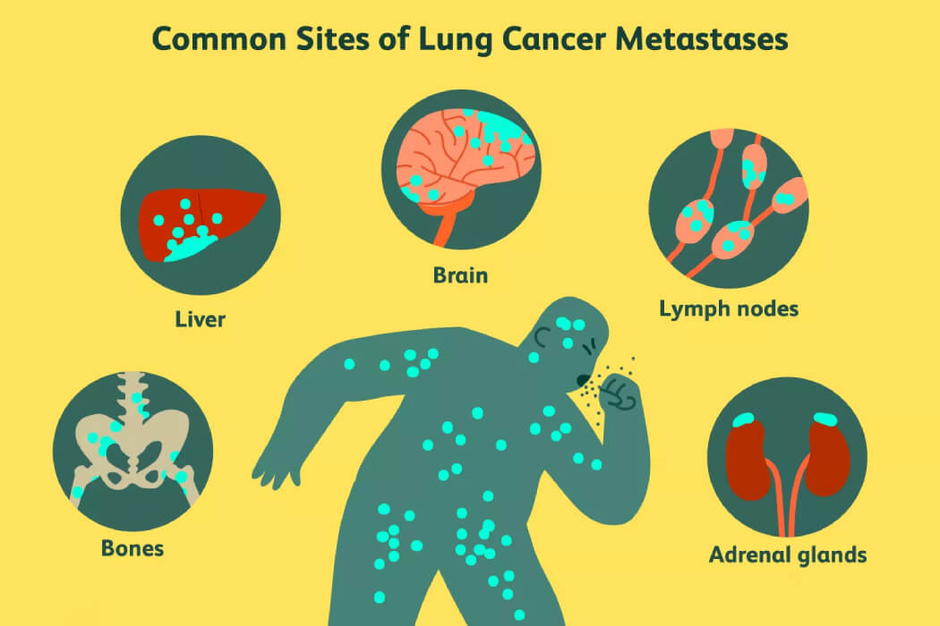 các vị trí di căn ung thư phổi