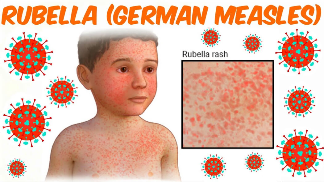 bệnh rubella