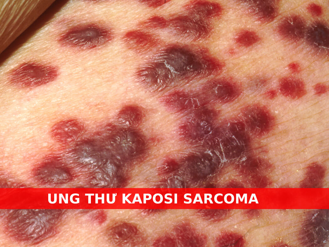 ung thư Kaposi sarcoma