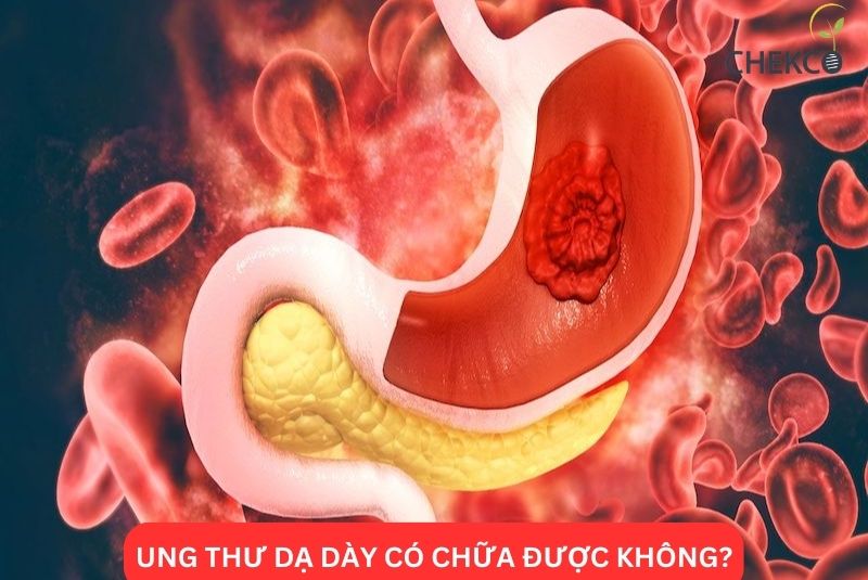 Ung Thư Dạ Dày Có Chữa Được Không?