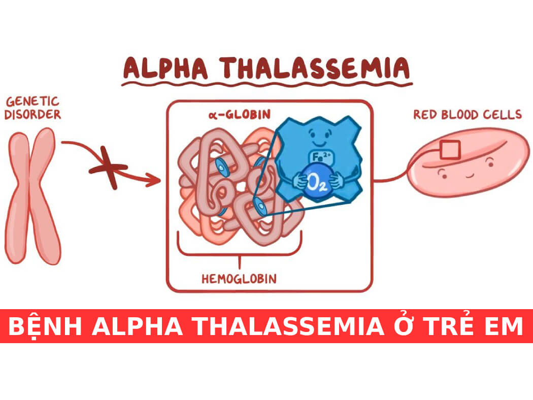 bệnh alpha thalassemia ở trẻ em