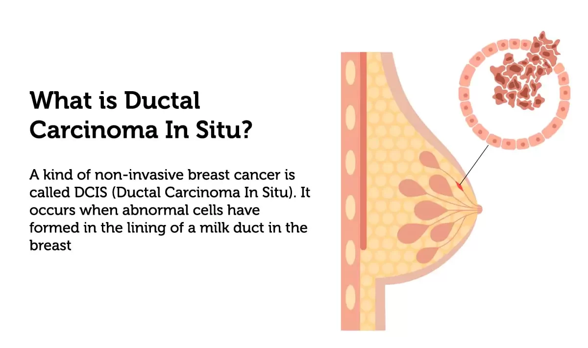 what is ductal carcinoma in situ e1709089311222
