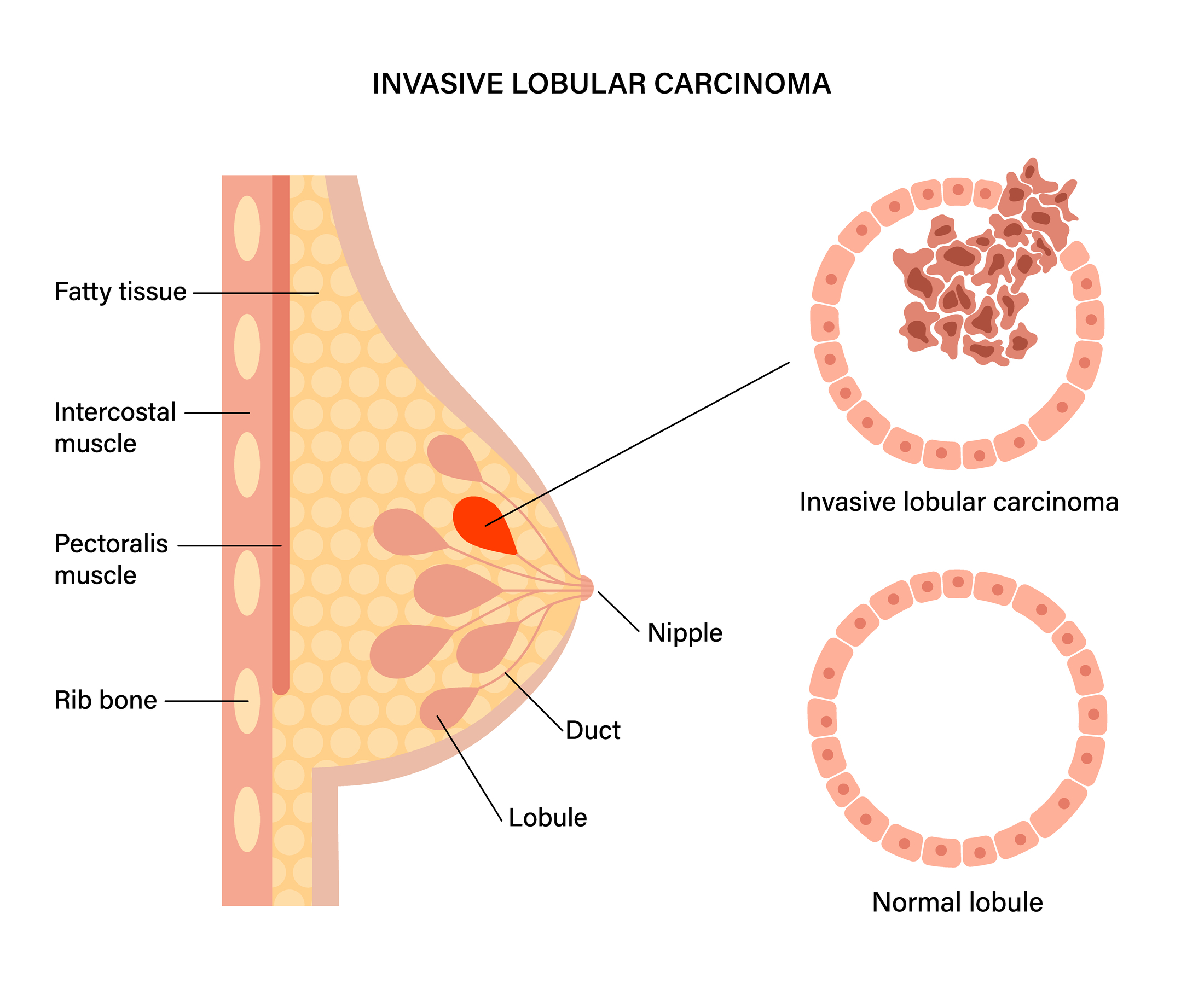 Lobular Carcinoma