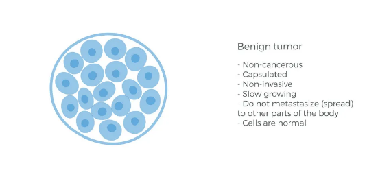 benign tumors vs cancerous tumors e1710315156691