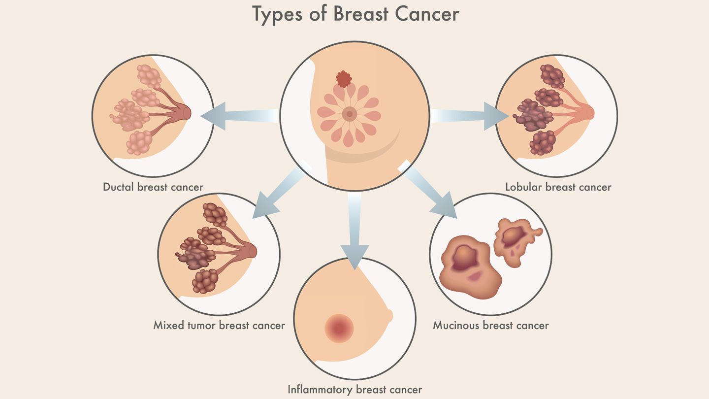 types of breast cancer guide 1440x810 1